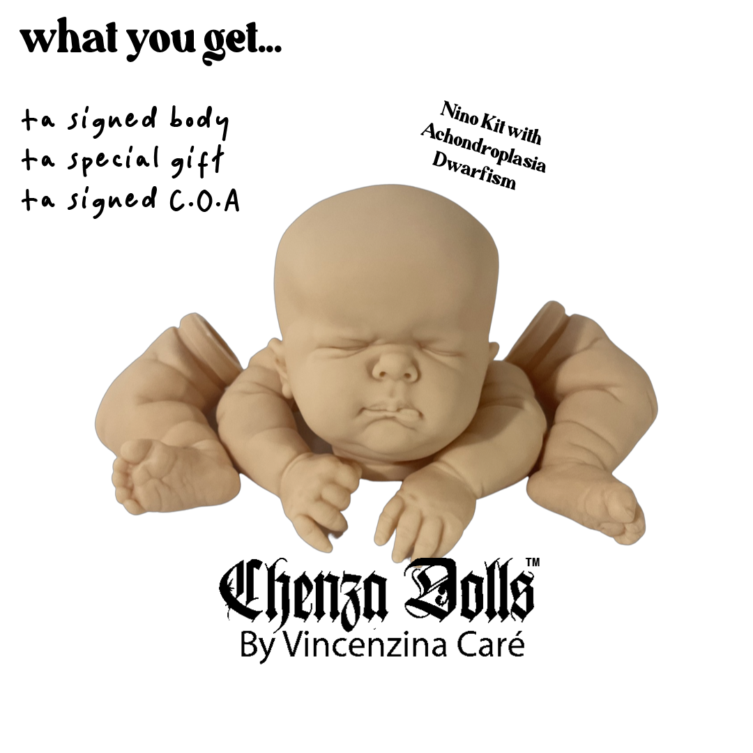 achondroplasia dwarfism baby